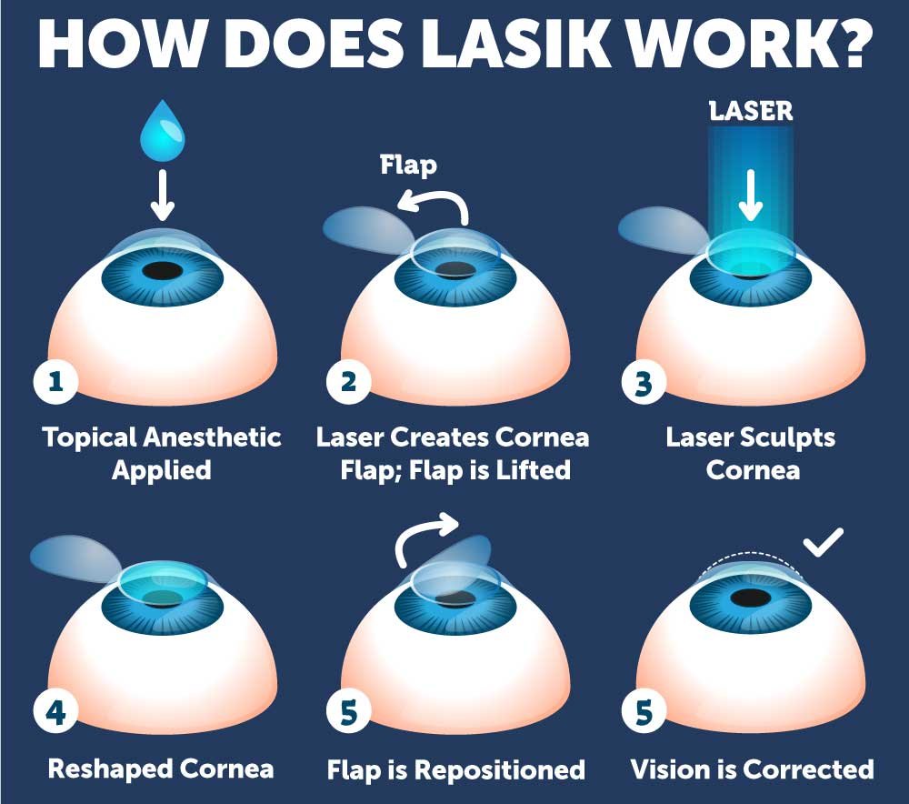 QUE ES LA CIRUGIA LASIK ? – Cirugia para la Presbicia